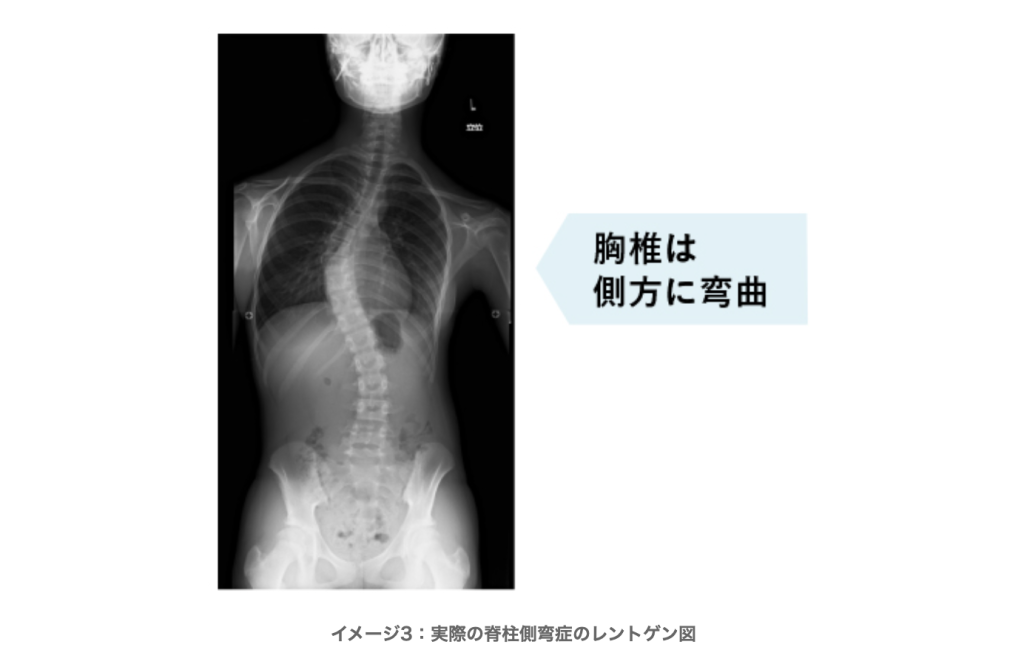 側弯症 背骨が曲がっているのを治すには からだ整骨院 からだ工房 公式サイト 佐賀県佐賀市